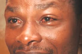 Red Eyes disease hits Kagadi