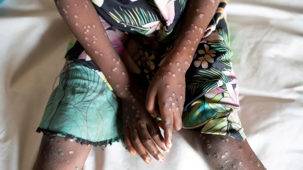 WHO forms  emergence committee on Mpox