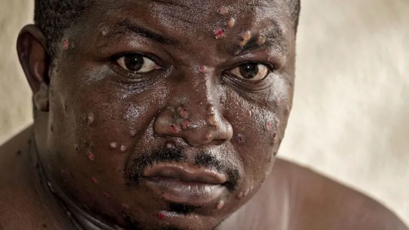 UNHCR Calls for Urgent International Support Amid Rising Mpox Outbreak in DRC and Neighboring Countries