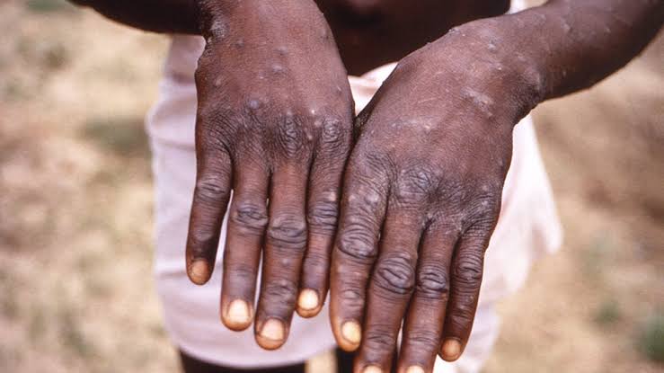 Uganda confirms two new Mpox cases in Kasese