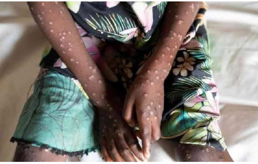 New Mpox Vaccines to Arrive in DRC tomorrow:WHO and EU Launch Critical Response
