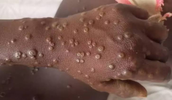 Kagadi health officials in drive to sensistise locals against Mpox, Ebola