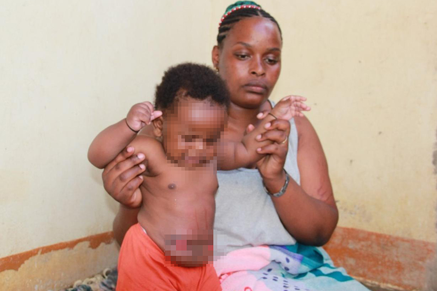 Baby Born Without Anus Seeks Shs3m for Surgery