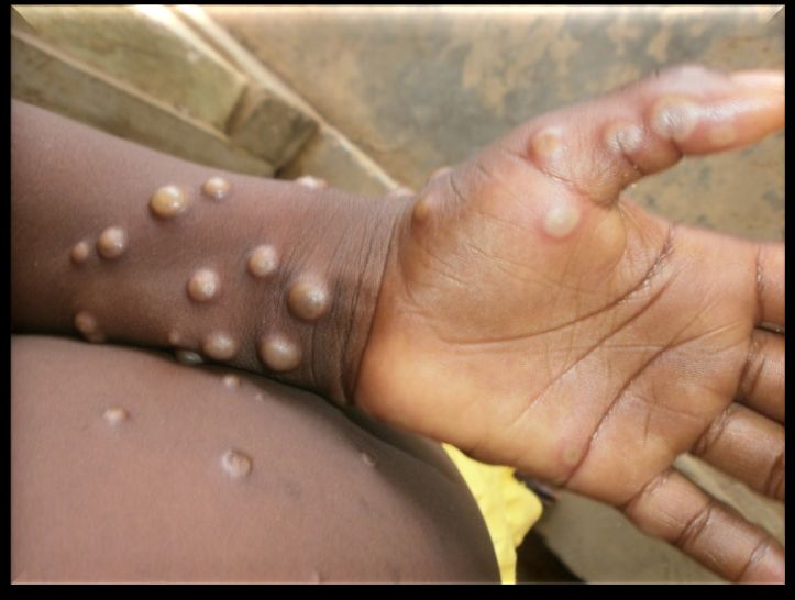 Uganda Records Fourth Mpox Death as Cases Surpass 800