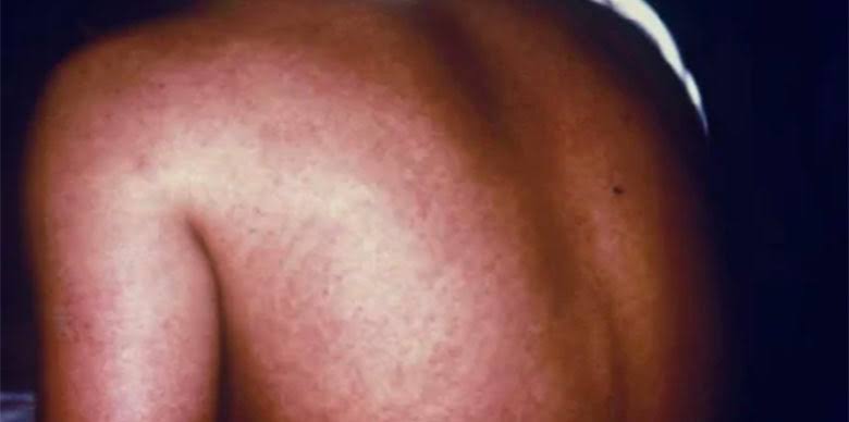 OPINION:Filoviruses in Uganda