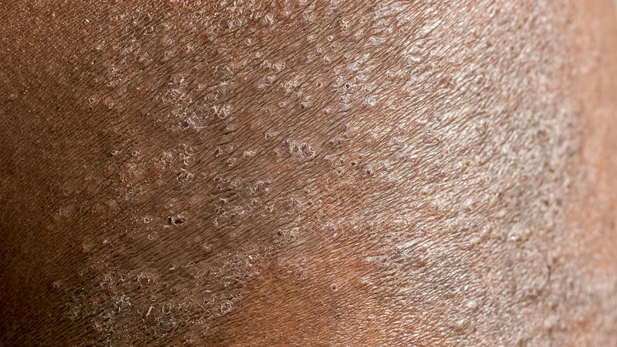 Clabane and Next Com Spark Vital Conversations on Eczema and Skincare on X Press