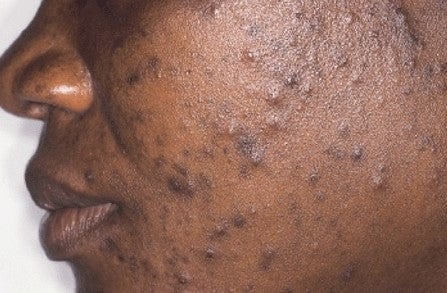 The Truth About Hyperpigmentation No One Tells Africans