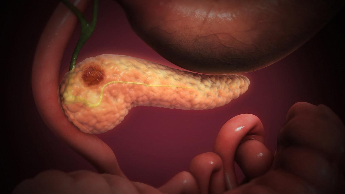 Hope Rises for Pancreatic Cancer Patients with Promising Triple-Drug Therapy