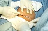 Why Kampala Is Recording Uganda’s Highest C-Section Rates