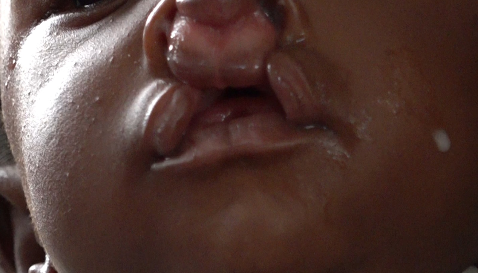 Cleft Condition Triggers Abandonment, Experts Warn