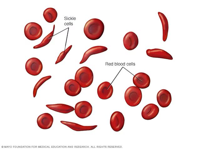 Gov’t to Expand Sickle Cell Care to Health Centre IIIs