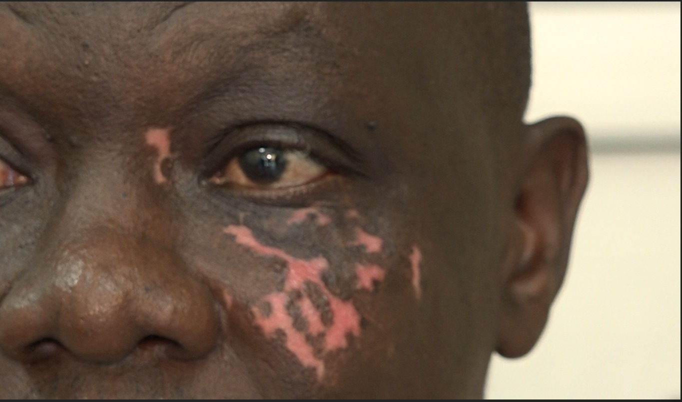 Dermatologists Dismiss Vitiligo Myths, Urge Early Treatment as Stigma and Misinformation Persist
