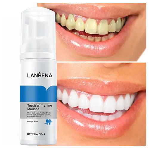 The rising trend of teeth whitening and related sensitivity issues
