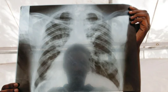 Health official sound alarm over surging tuberculosis cases
