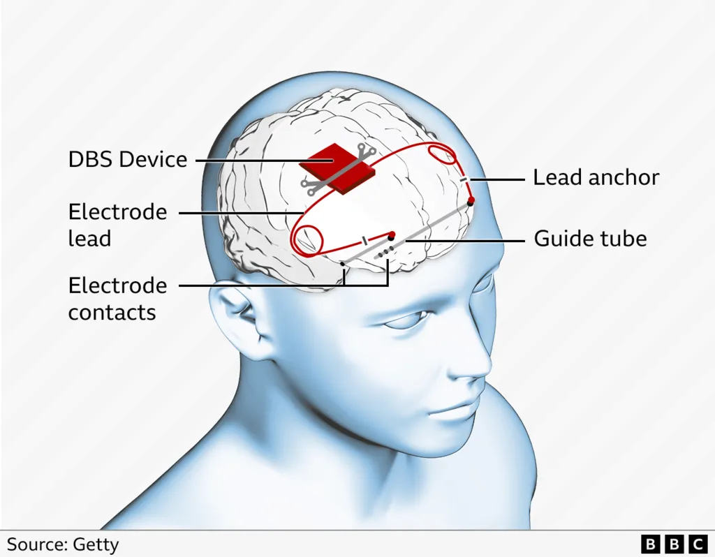 World first epilepsy device fitted in UK boy's skull