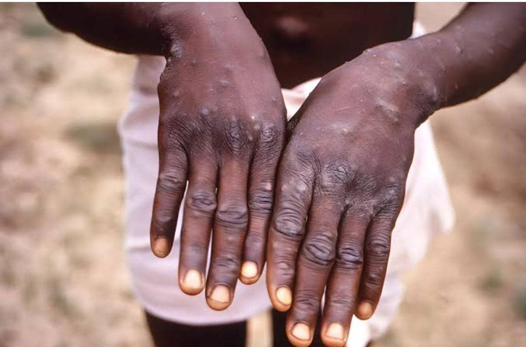 Public Warned Against Turning to Native Healers for Mpox Symptoms