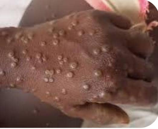 Ankole at risk of Mpox outbreak, health officials warn