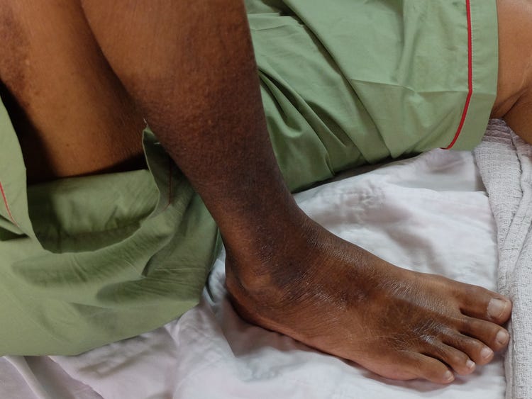 Why we are all vulnerable to blood clots!