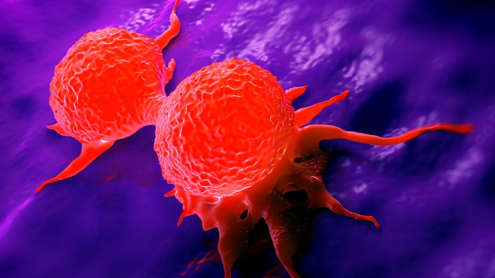 "Metal detector" to find breast cancer spread being tested