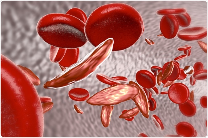 Sickle Cell disease in Uganda: Prevalence, challenges, and progress