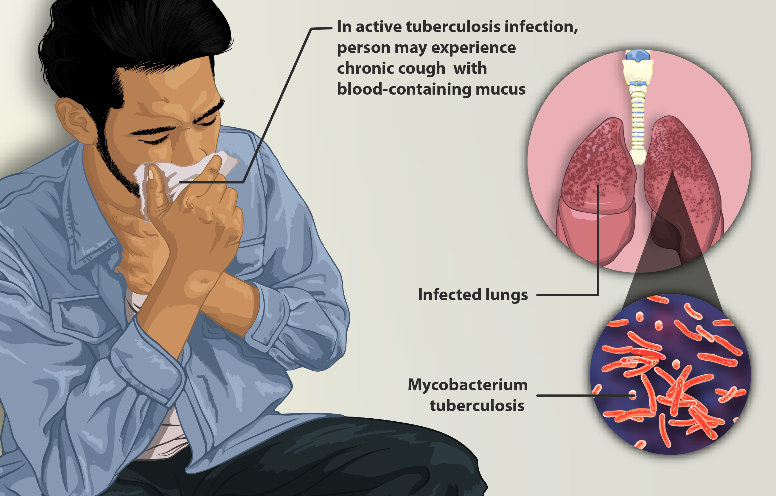 Health experts concerned over rise in multi-drug resistant tuberculosis cases