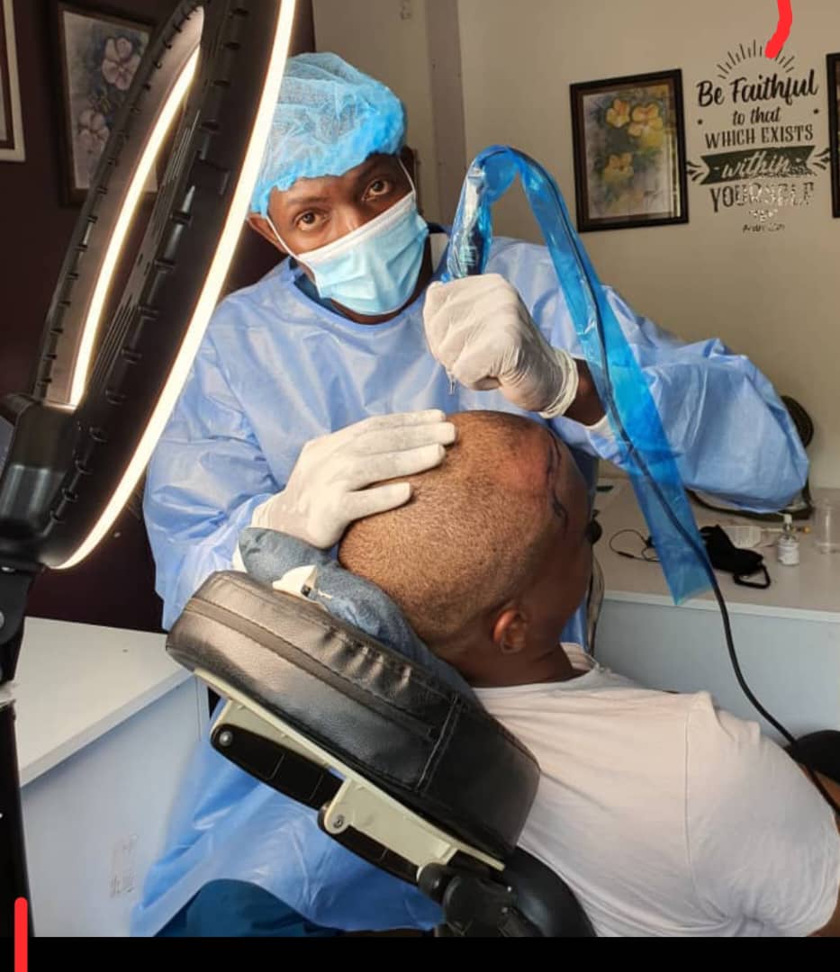 Scalp Micro pigmentation: the practical solution to your breaking and disappearing hair