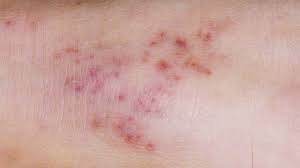 WHO Launches Global Guidelines on Meningitis Diagnosis, Treatment, and Care