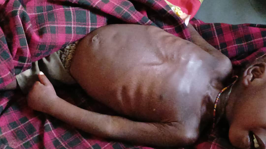 Alarming Malnutrition Hits Nakapiripirit