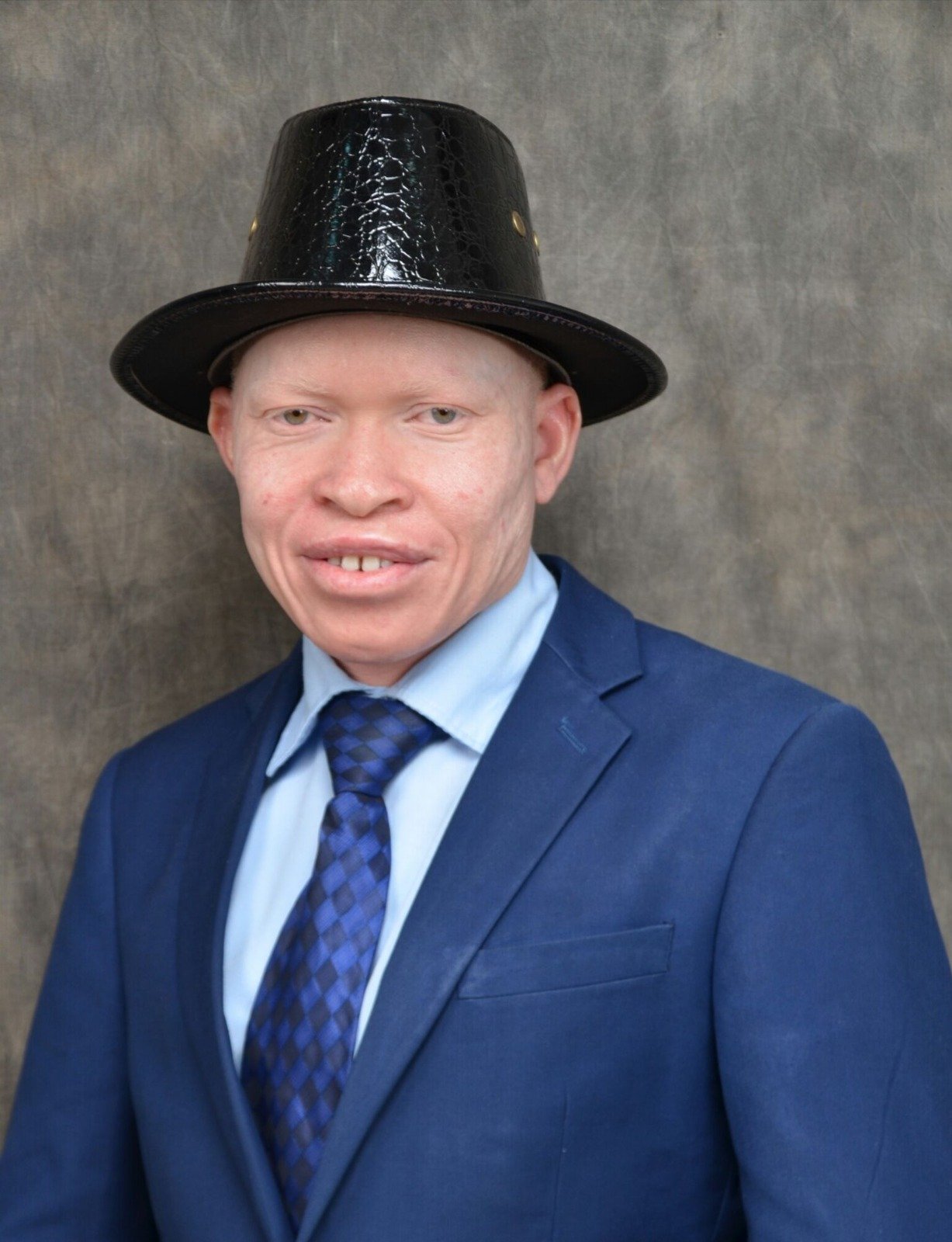 The Hidden Struggles of Living with Albinism in Uganda