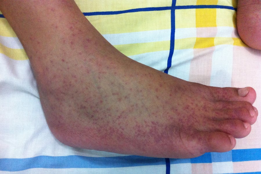 WHO Warns Chikungunya Outbreak Fast-Spreading from Indian Ocean to Africa